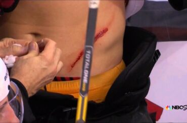 Brayden Schenn takes skate cut to stomach
