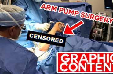 *GRAPHIC CONTENT* I got Arm Pump surgery! Does it work?