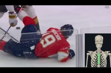 Matthew Tkachuk Chest Injury - Dr. Wilson Explains