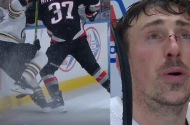 Brad Marchand Bleeding After Elbowed By Casey Mittelstadt