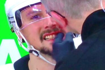 Penguins D #65 Erik Karlsson takes a puck to his face. Needs stitches.